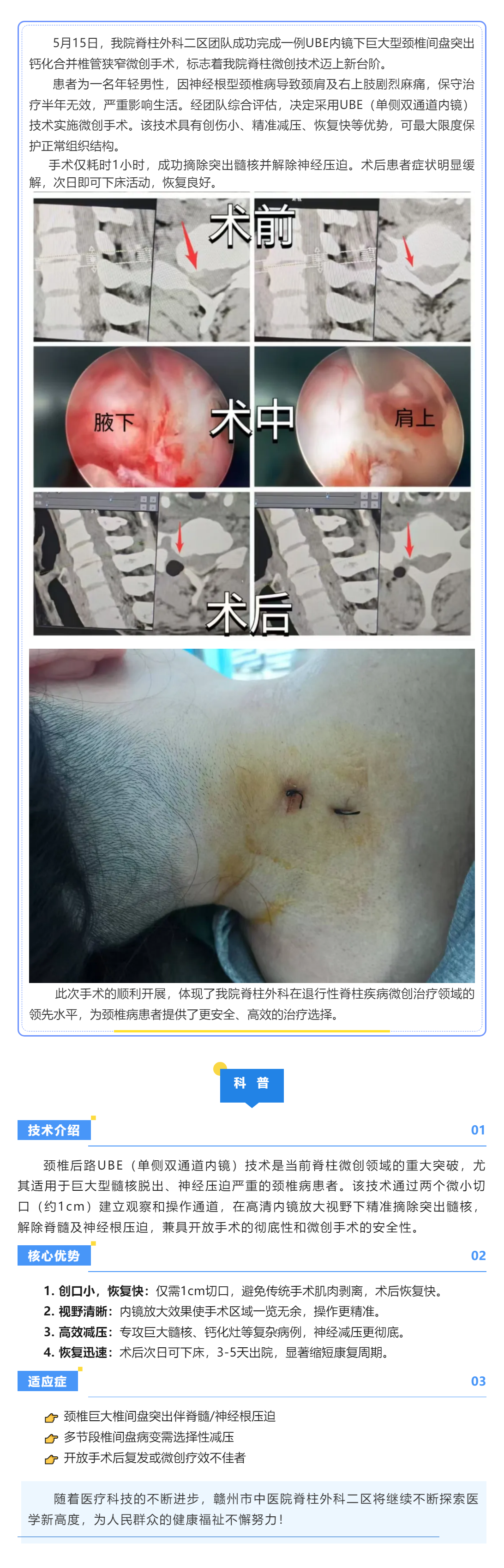 當天手術→次日下床：UBE技術讓頸椎病康復快3倍！.png